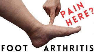 Foot Arthritis Pain: Most Common Signs and Symptoms | Doovi