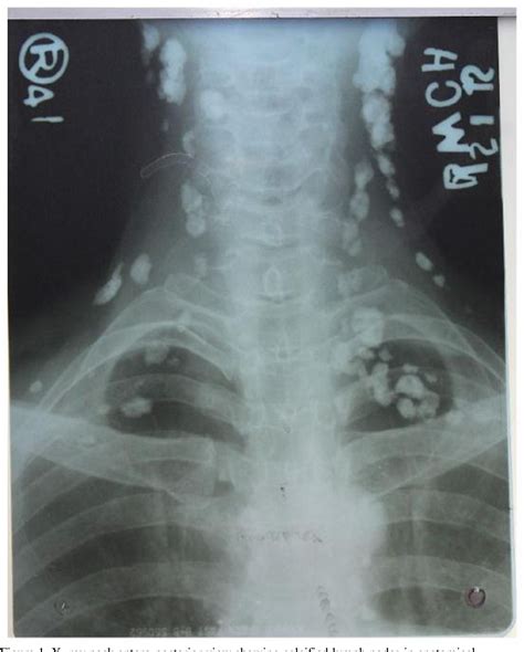 [PDF] Calcified cervical lymph nodes - a unique picture | Semantic Scholar