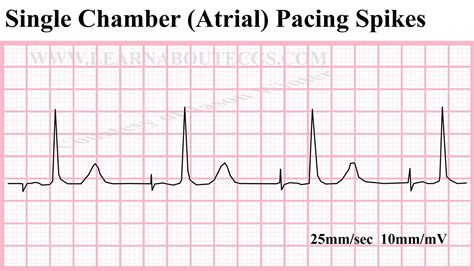 Single Chamber Atrial Pacing Spikes ECG by ELECTROCARDIOLOGY