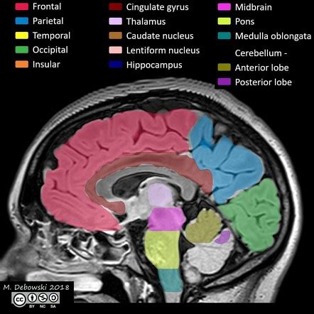 Brain lobes - annotated MRI | Image | Radiopaedia.org