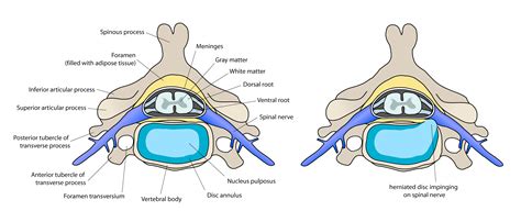 Spinal Disc Herniation | Bone and Spine