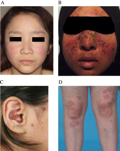 LE specific skin lesions: (A) Malar (butterfly) rash (mild symptom ...