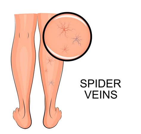 Spider veins Guide: Causes, Symptoms and Treatment Options