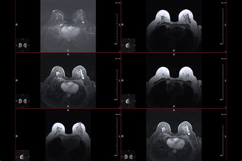 Breast MRI: What Is It, Procedure and Results