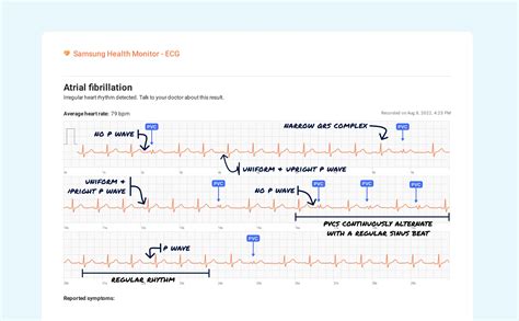 Ventricular Bigeminy Vs. Ventricular Trigeminy on Your Watch ECG | Qaly