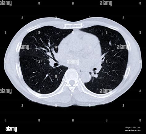 CT scan of Chest or lung for screening lung nodules and lung cancer Stock Photo - Alamy