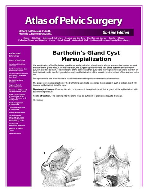 Bartholin's Gland Cyst Marsupialization | PDF | Vagina | Surgery