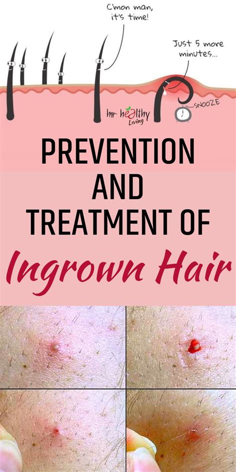 Pin by Ingrown Hair Neck on Medium Length Hair | Ingrown hair treatment, Ingrown hair, Ingrown ...