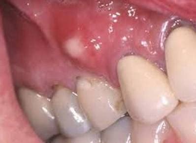 White Bump on Gums: Causes and Treatment | UtoDent.com