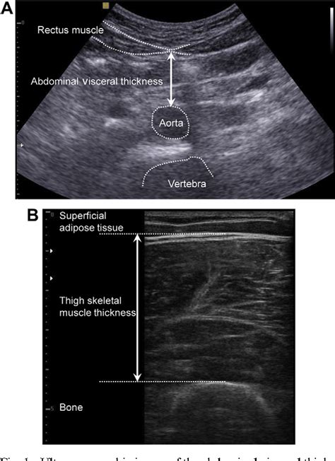 A simple ultrasound correlate of visceral fat. | Semantic Scholar