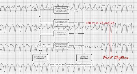 ECG Rhythms: Wide QRS Tachycardia