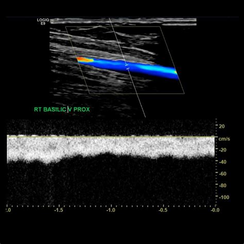 Upper Extremity Venous Doppler – Sonographic Tendencies | Vascular ultrasound, Medical ...