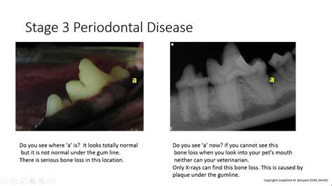 Periodontal Disease Stages