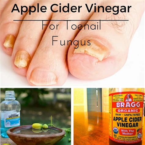 Apple Cider Vinegar For Toenail Fungus