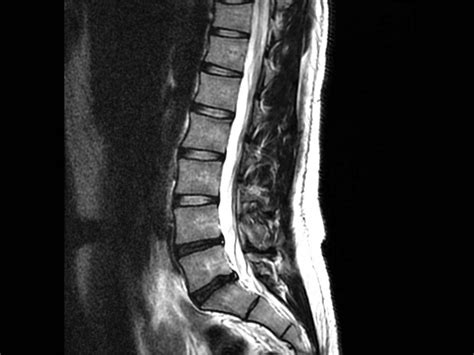 Back Pain and Normal MRI, is it possible?: Advanced Pain Management Center: Interventional Pain ...