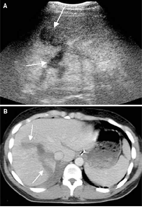 Liver trauma. (A) CEUS detects a complex hepatic laceration (arrows).... | Download Scientific ...