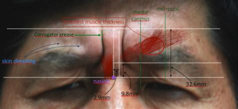 #1-2. Upper Face: Forehead & Glabella | D&PS