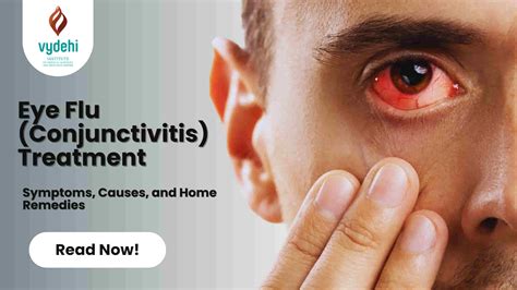 Eye Flu Treatment: Symptoms, Causes, and Home Remedies