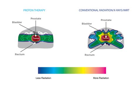 Proton Beam Therapy – Tennessee Oncology Proton Center