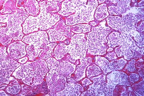 Bronchopneumonia Histology