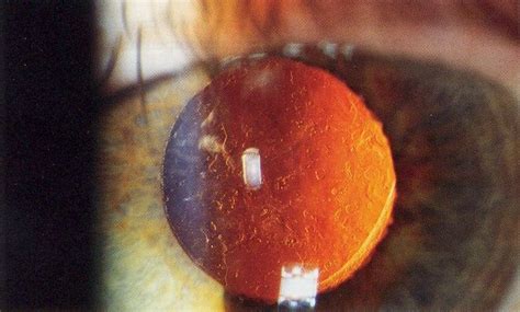 Secondary Cataracts | A Patient Guide to Diagnosis & Treatment