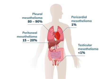 4 Types of Mesothelioma | Cell Location, Cell Type and Treatment