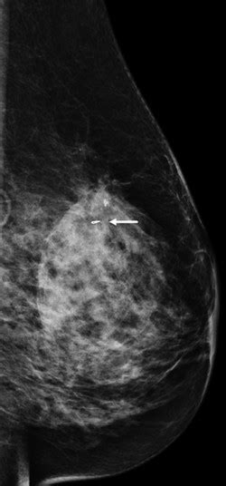 Focal Asymmetry with Architectural Distortion | Radiology Key