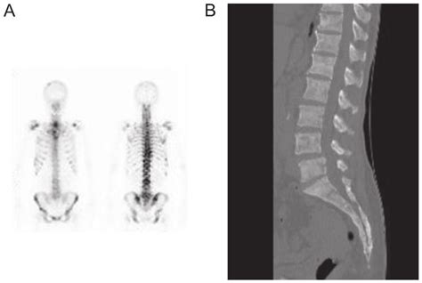 Case 1: (A) Bone scintigraphy showed multiple abnormal uptake of ...