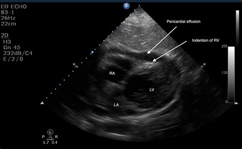 Pericardial Effusion-> Tamponade? ~ Ultrasound Cases Info