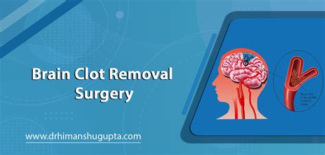 Brain Clot Removal Surgery in Jaipur - Dr. Himanshu Gupta