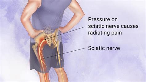 Sciatica and Trapped Sciatic Nerve | Heales Chiropractic Clinic