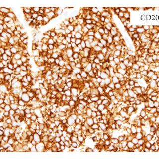 (a) Wright–Giemsa stain of peripheral blood smear shows circulating... | Download Scientific Diagram