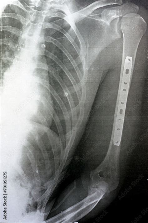 Plain x ray showing transverse midshaft left humerus fracture caused by ...