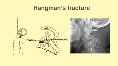 Hangman's Fracture |C2 fracture |Cervical spine fracture - YouTube