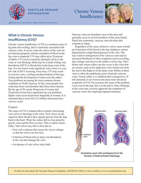 (PDF) chronic venous insufficiency (CVI) - · PDF fileChronic venous insufficiency (CVI) is a ...