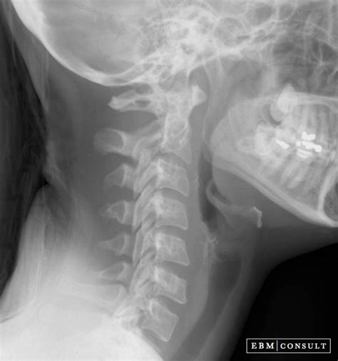 Lateral Cervical Spine Radiograph (X-Ray) - How to Read | Cervical, X ray, Cervical vertebrae