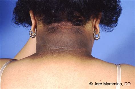 Acanthosis Nigricans - American Osteopathic College of Dermatology (AOCD)