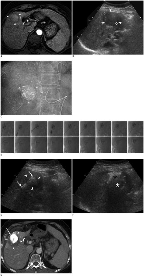 69-year-old female with hepatocellular carcinoma (HCC) of liver. A.... | Download Scientific Diagram