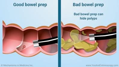 Colonoscopy Bowel Preparation