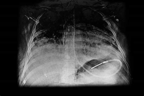 Chest X- ray showing nasogastric tube dobhoff for feeding - image