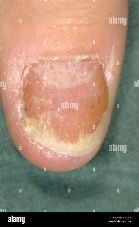 Onycholysis nail hi-res stock photography and images - Alamy