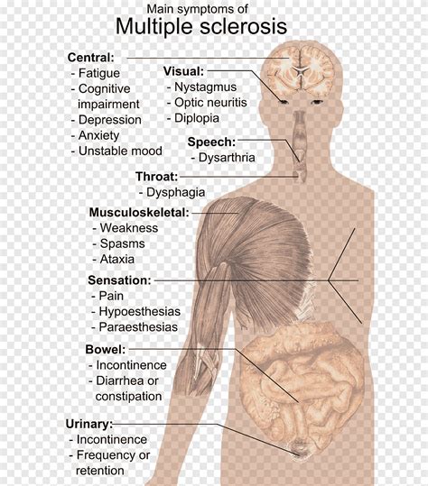 Multiple sclerosis signs and symptoms Multiple sclerosis signs and symptoms Medical sign Neck ...