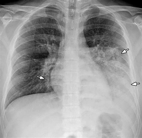 Pneumonia Radiograph