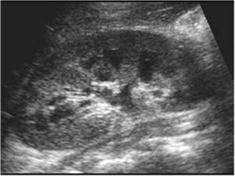 Pediatrics | 9.2 Pediatric urinary tract : Case 9.2.2 Reflux | Ultrasound Cases