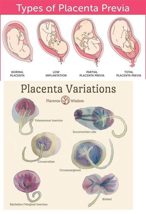 Placenta variations and what they look like - NCLEX Quiz