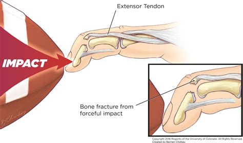 지골골절(phalanx fx.), 망치손가락(mallet finger), 견열골절(avulsion fx.), 류마티스 관절염(rheumatic arthritis) xray ...