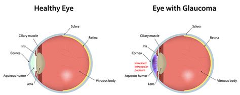 Glaucoma Indianapolis | Glaucoma Greenwood | Lanter EyeCare