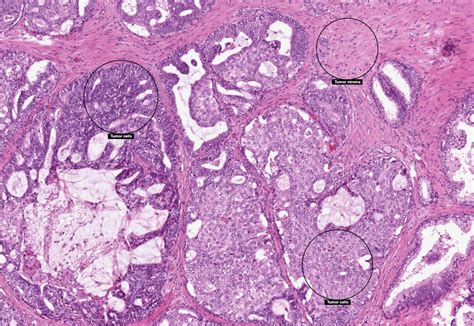 Prostate Carcinoma Histology | The Best Porn Website