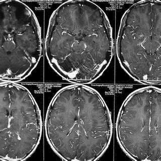 MRI brain showing T1 hypointense and T2/FLAIR hyperintense lesions in... | Download Scientific ...