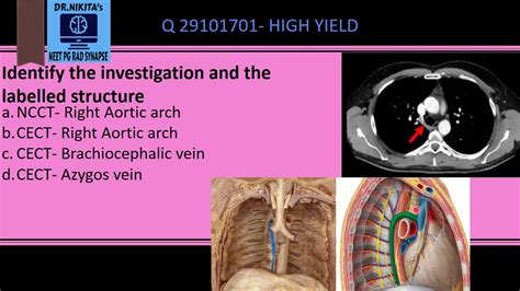 IDENTIFYING AZYGOS VEIN ON CT - YouTube